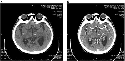 Analysis of characteristics of intracranial cavernous angioma and bleeding factors in middle-aged and elderly patients